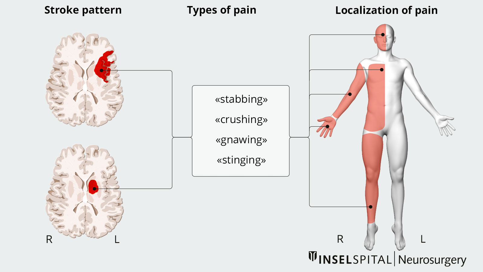 Drawing of neuropathic pain with stroke pattern, pain character and pain distribution.