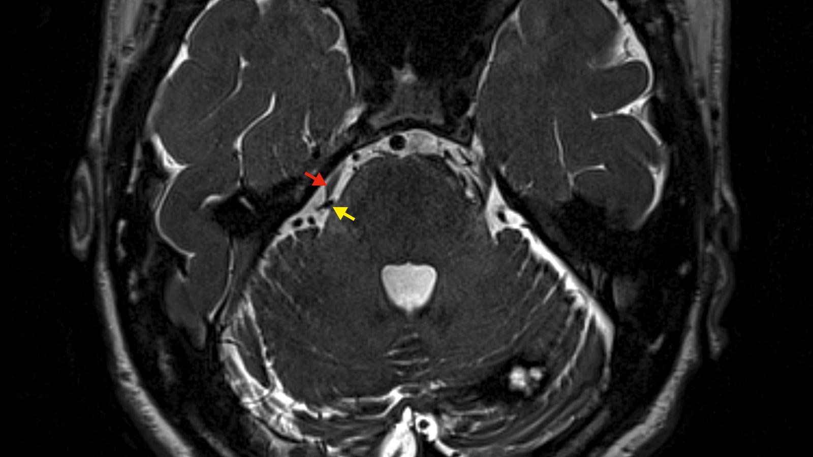 Image IRM d'une névralgie du trijumeau