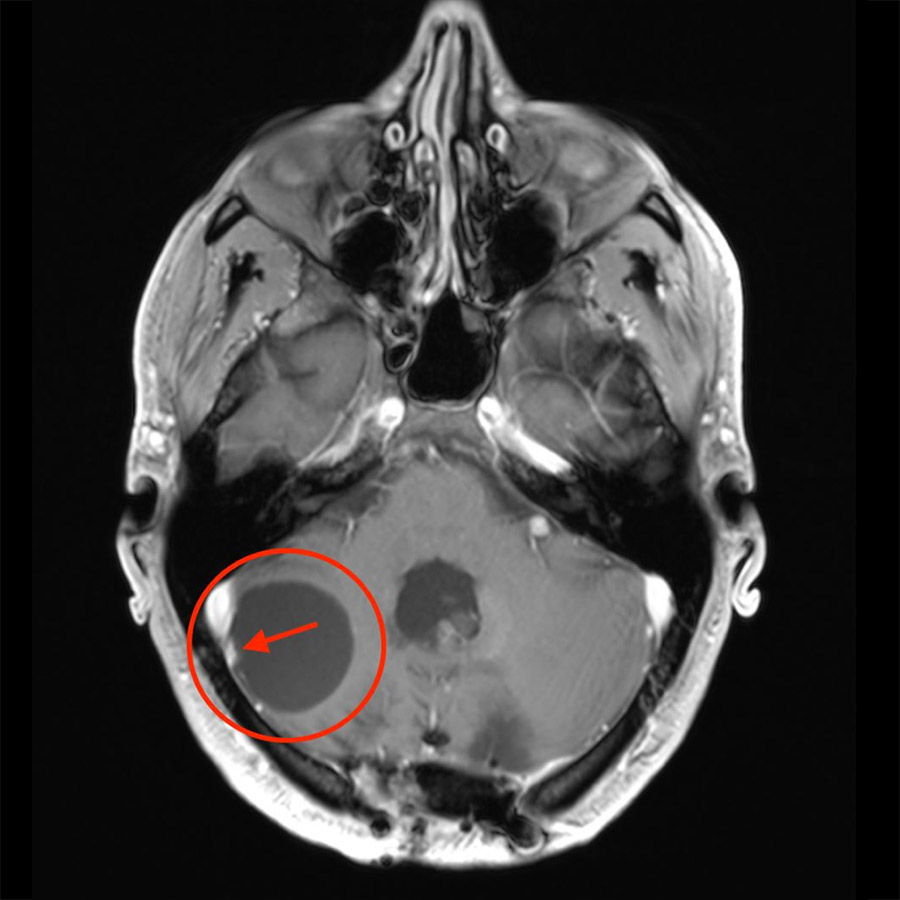 ​Im MRI-Bild sieht man den soliden Anteil des Hämangioblastoms in weiss (gekennzeichnet durch roten Pfeil), den zystischen Anteil in schwarz.