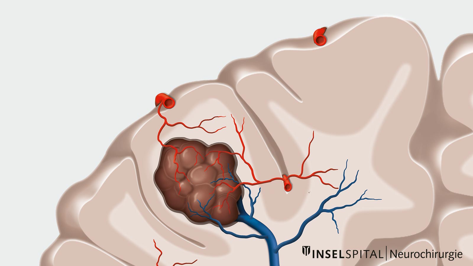 Le cerveau. Une veine (en bleu) et des veines (en rouge) font saillie dans le cavernome (en brun).