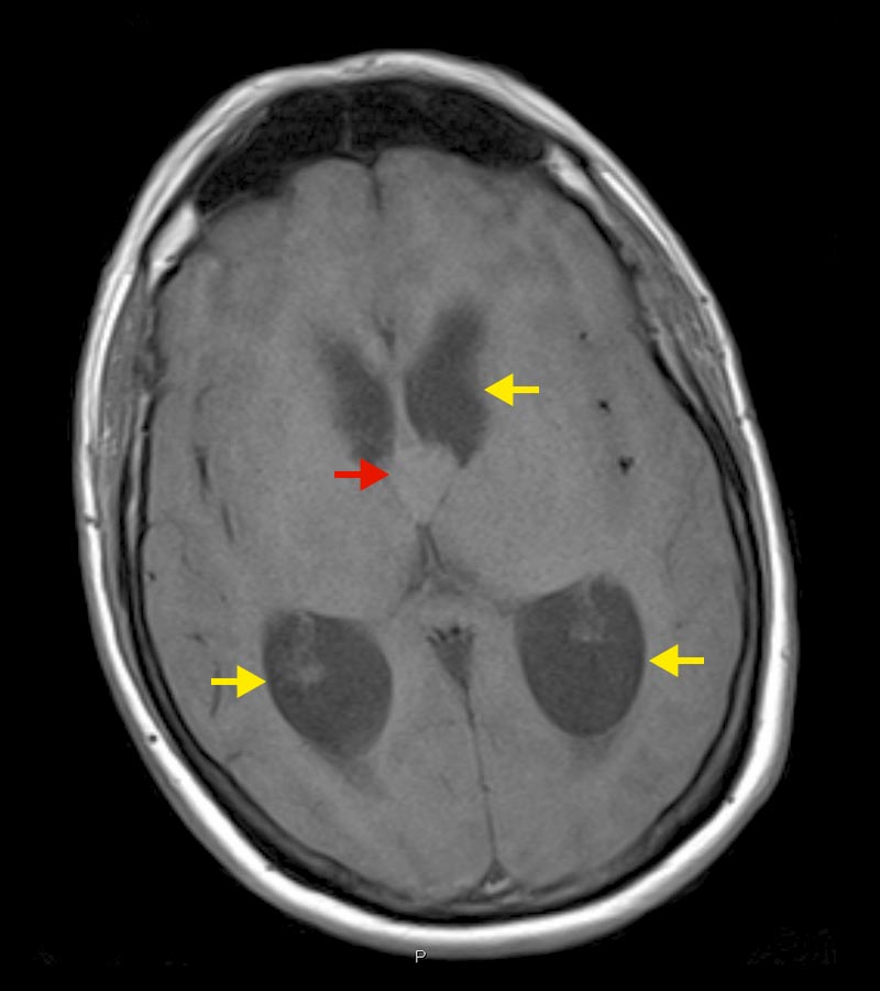 MRI-Bild axial mit Kolloidzyste und erweiterten Seitenventrikeln