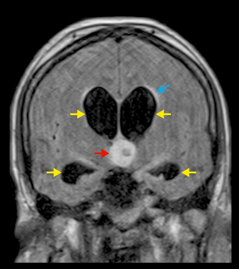  Image IRM d'un kyste colloïde avec diapédèse du liquide céphalorachidien et accumulation aiguë de liquide céphalorachidien. 