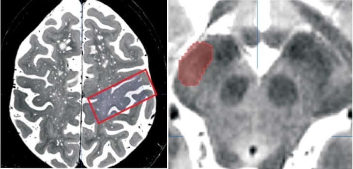 T2-weighted MRI images with marked regions of interest