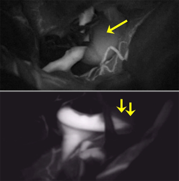 ICG-Angiografie-Bilder eines Aneurysmas: mit Durchfluss und mit Gefässverschluss