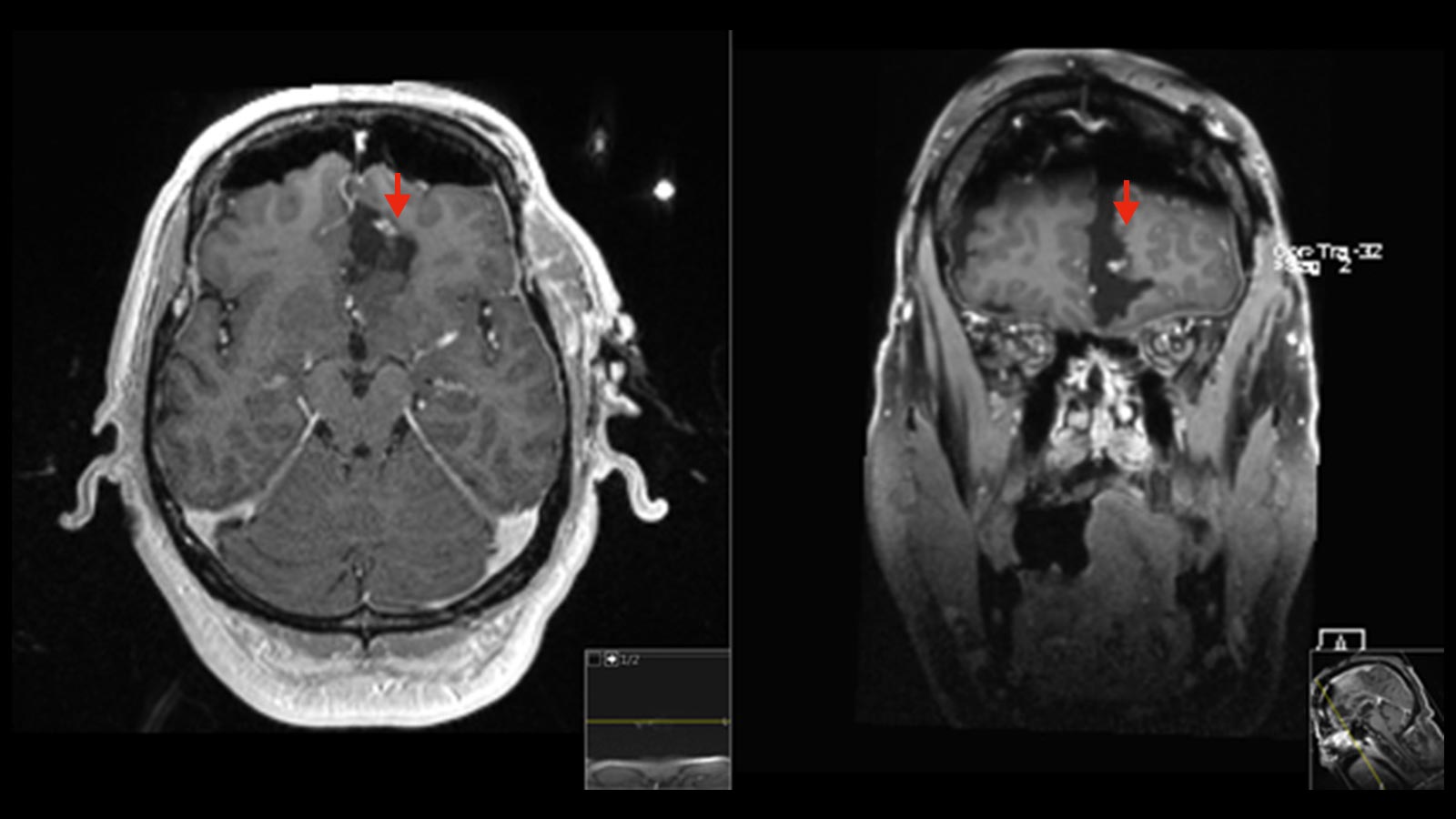 MRI-Bilder zeigen nach Resektion noch eine leichte Kontrastmittelaufnahme