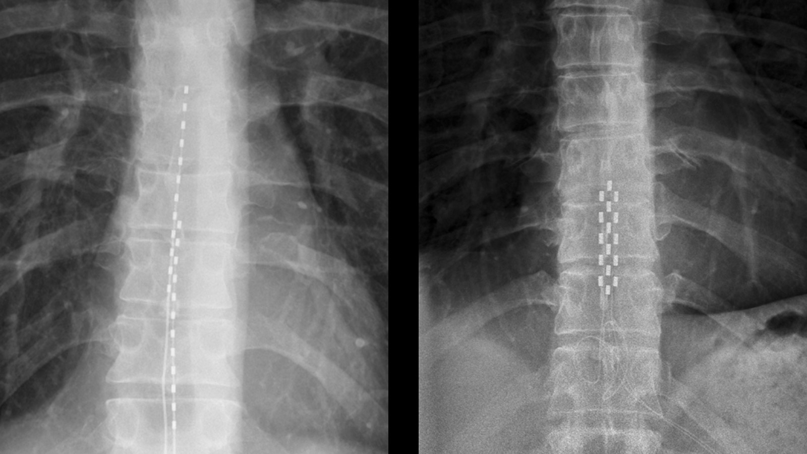 Radiographies d'une tige-électrode implantée (à gauche) et d'une plaque-électrode implantée (à droite)