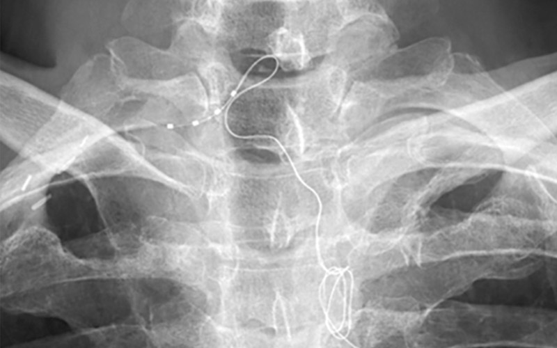 Radiographie des électrodes appliquées