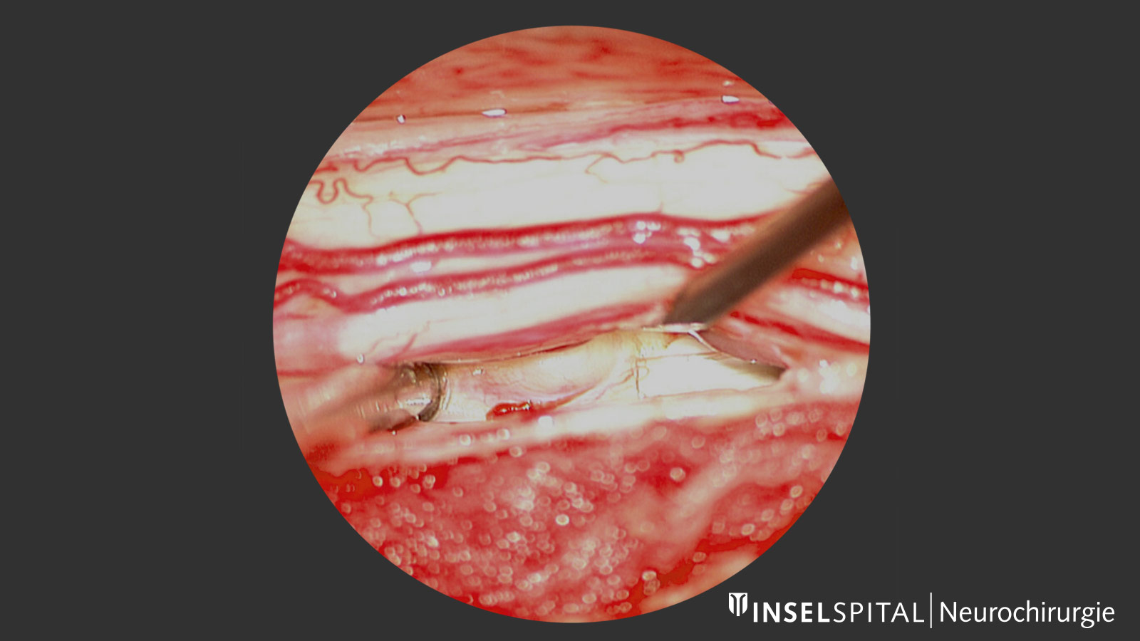 View through surgical microscope on spinal cord herniation