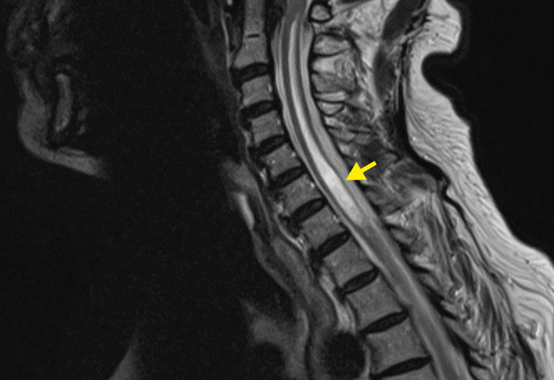 ​MRI-Aufnahme einer hell sichtbaren Syringomyelie, die mit einem gelben Pfeil markiert ist