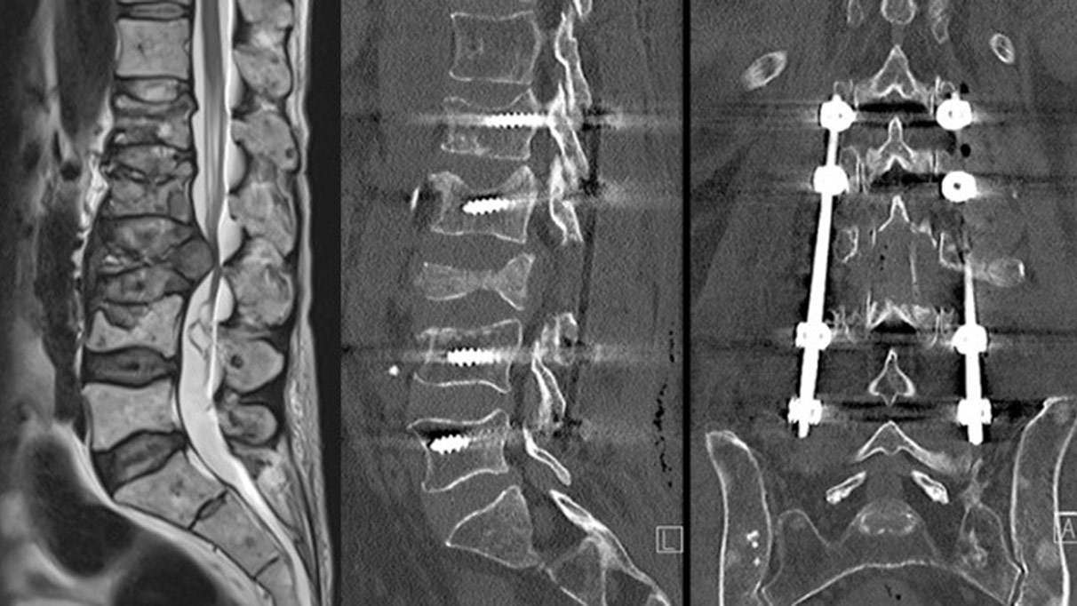 Image of a vertebral metastasis before and after stabilization and laminectomy