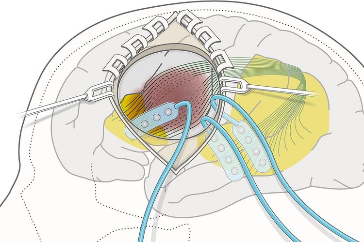 Schematische Darstellung einer minimalinvasiven Kraniotomie mit IONM