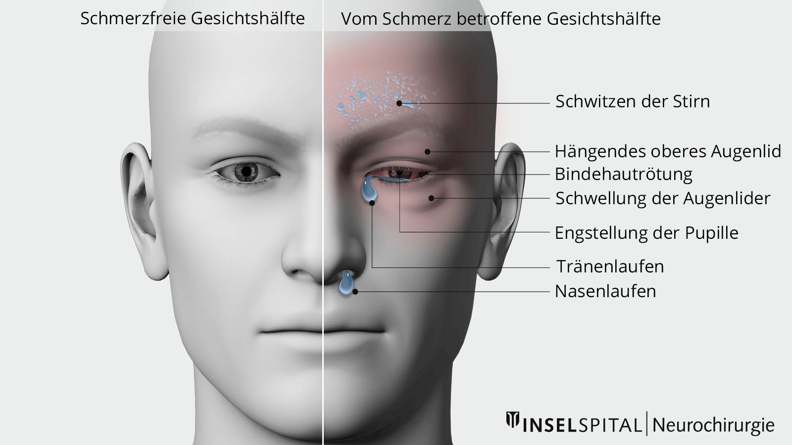 2-teilige Gesichtszeichnung. In eine Hälfte sind Begleitsymptome der Cluster-Kopfschmerzen eingezeichnet.