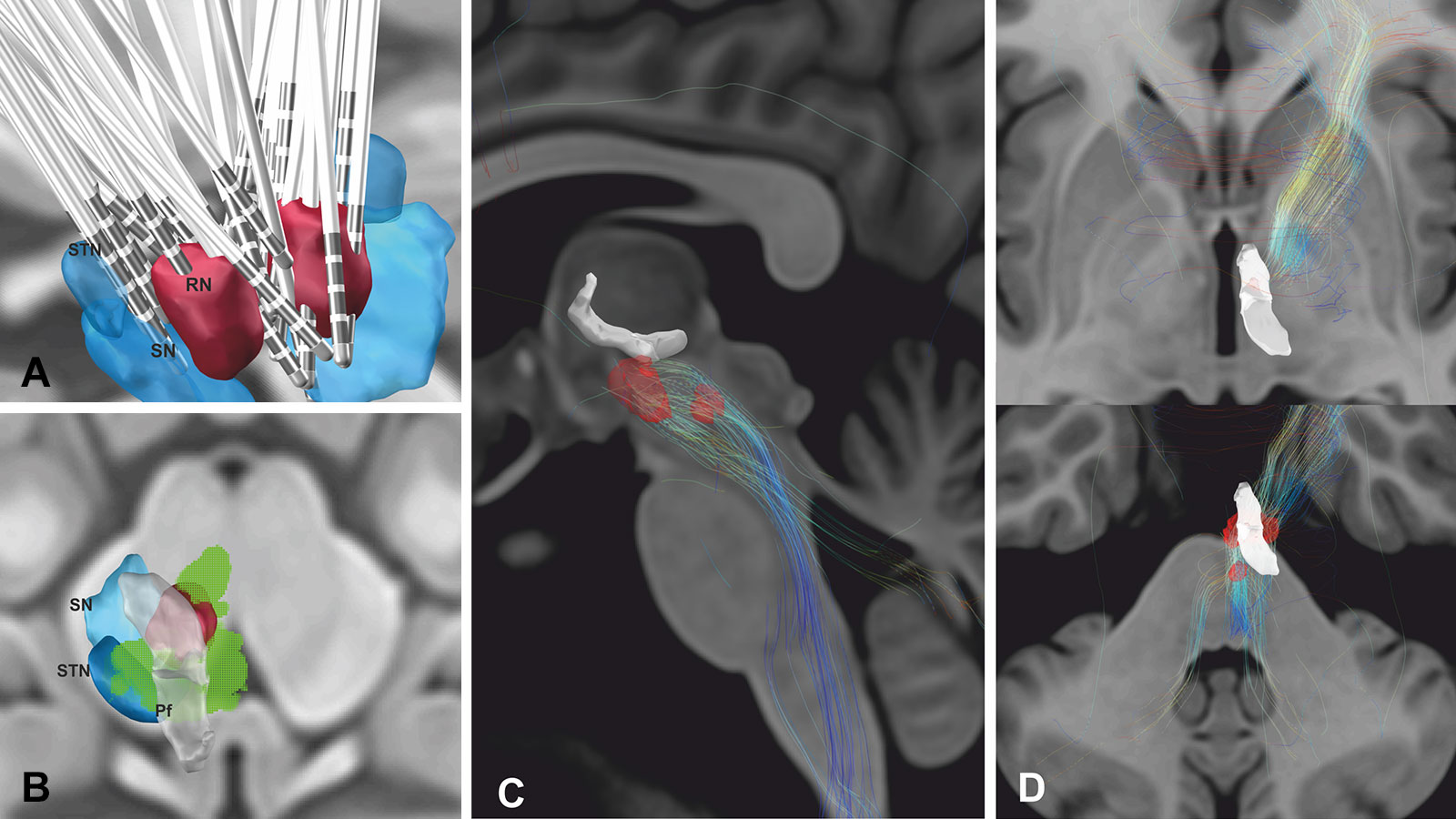 4-teilige Abbildung zeigt Elektrodenlage und wirksame Stimulationsfelder der DBS bei Cluster-Kopfschmerzen