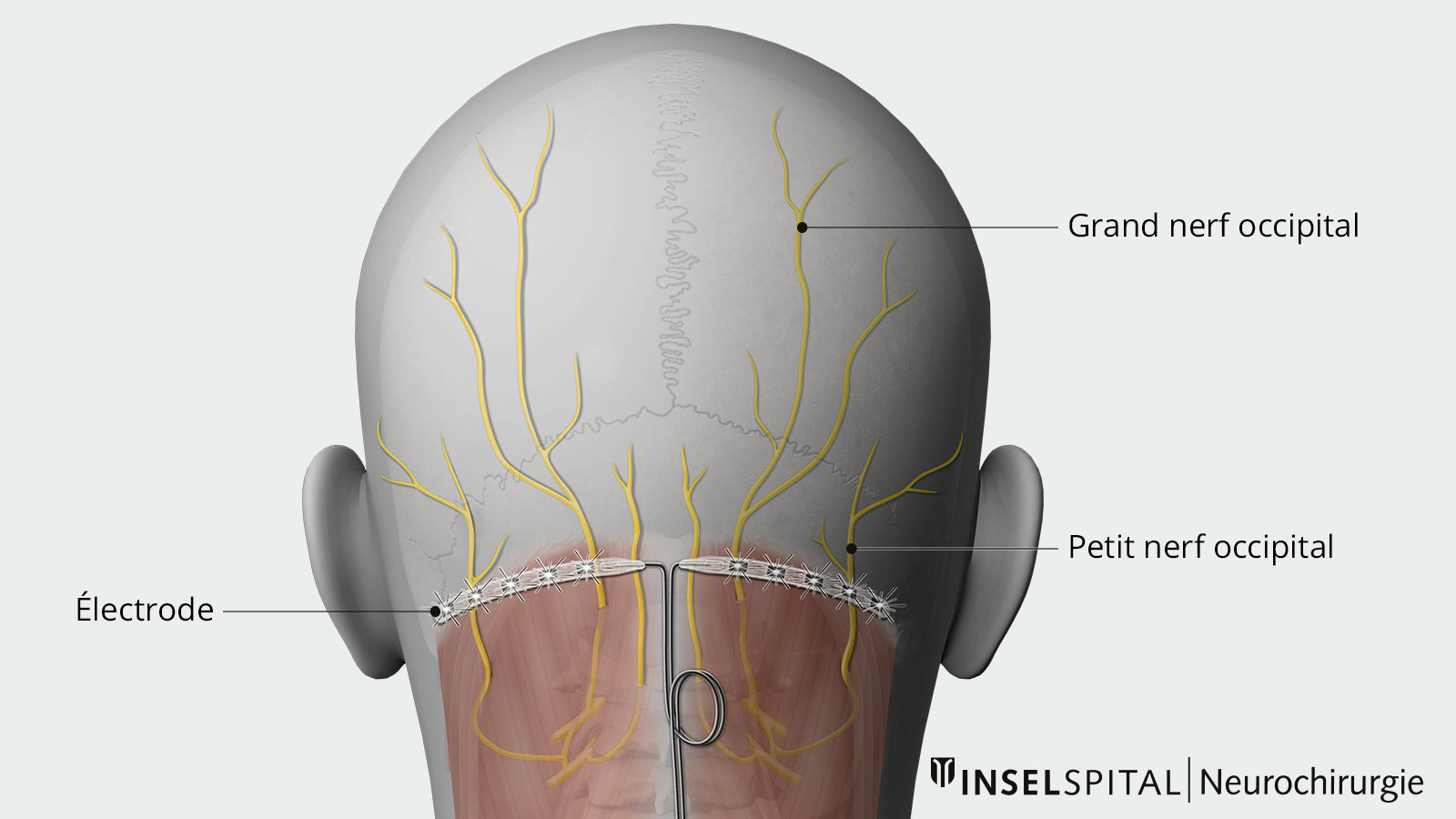 Plan d'ensemble de la stimulation du nerf occipital avec position des électrodes et des nerfs
