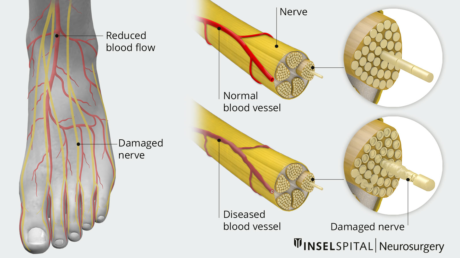  The drawing shows a foot with reduced blood flow and damaged nerves on the left, and the difference between healthy and damaged nerf on the right.