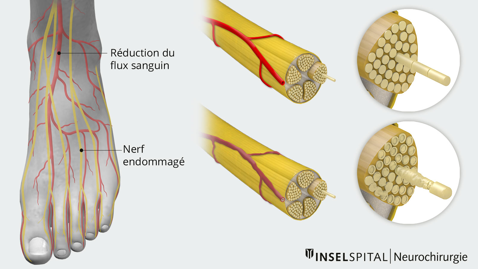 Le dessin montre à gauche un pied avec un flux sanguin réduit et des nerfs endommagés, et à droite la différence entre un nerf sain et un nerf endommagé.