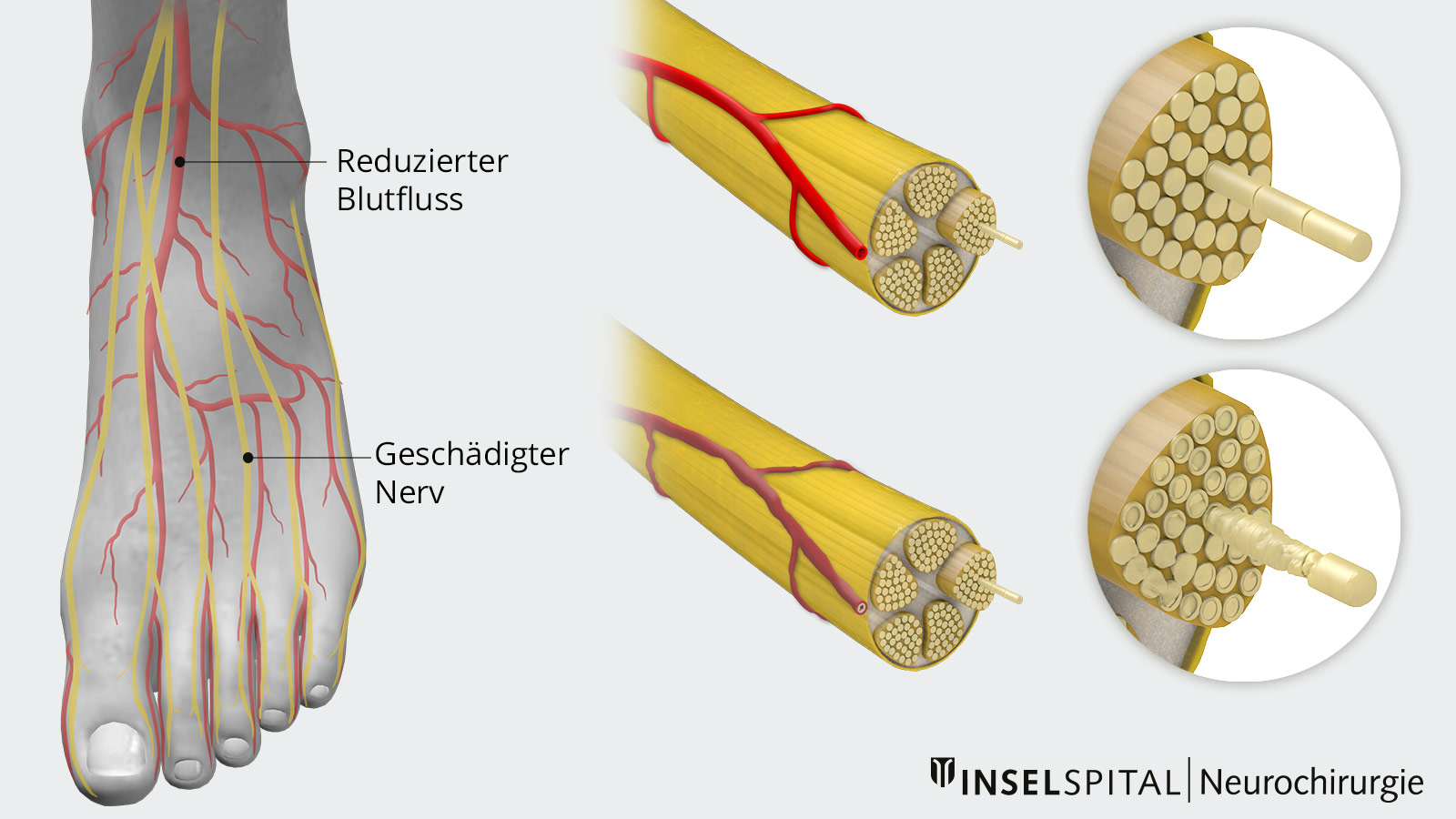 Die Zeichnung zeigt links einen Fuss mit reduzierten Blutfluss und geschädigten Nerven, rechts den Unterschied zwischen  gesundem und geschädigtem Nerf.