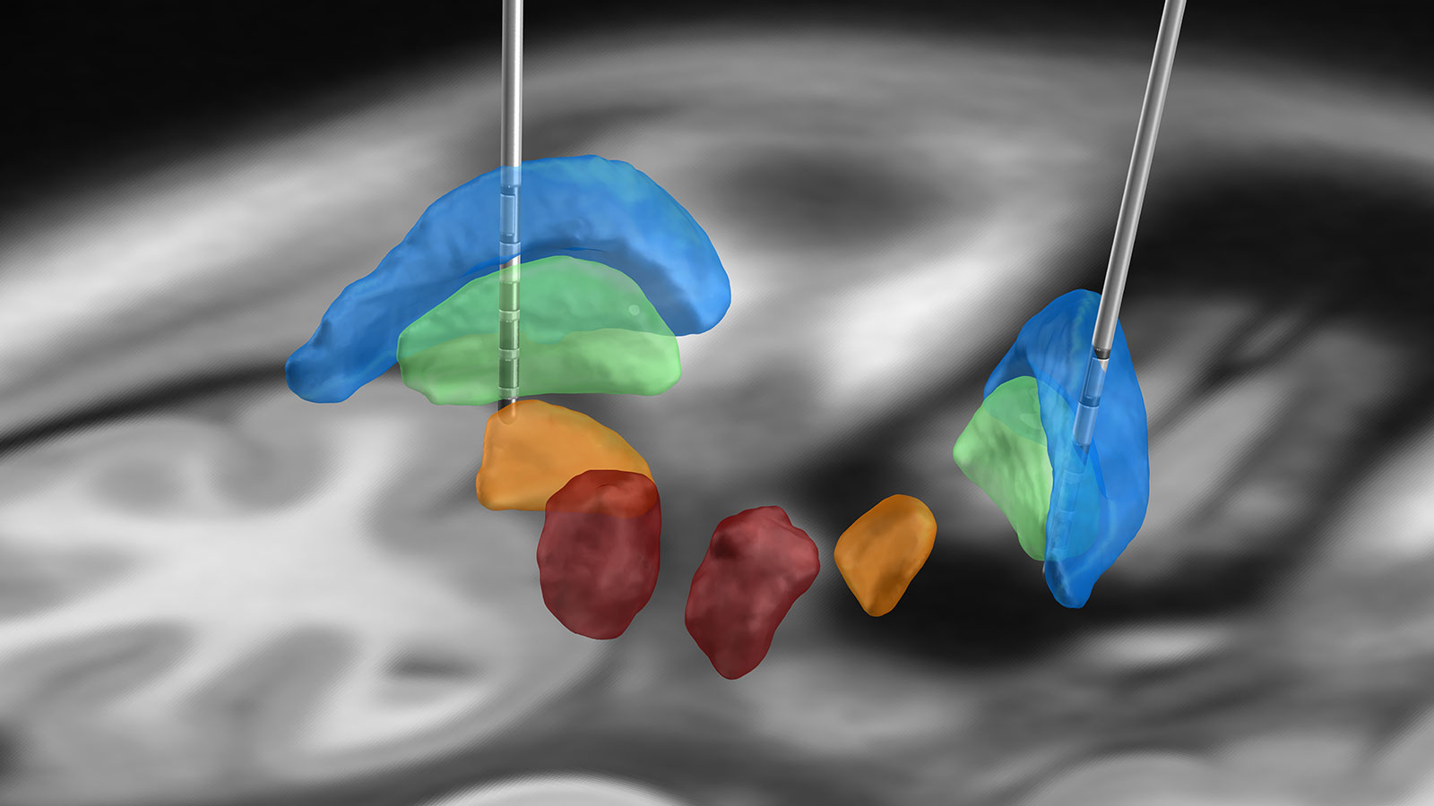 The figure shows the use of two DBS electrodes in the area of the globus pallidus internus (marked in green) for the treatment of dystonia.