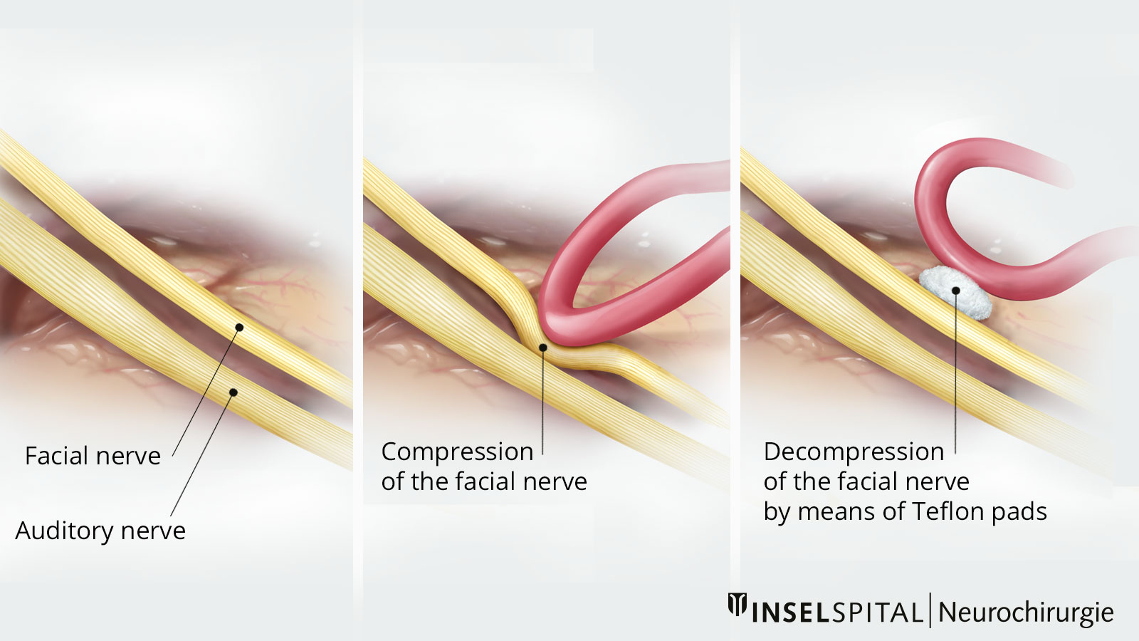 Three-part drawing for decompression of the facial nerve. A Teflon pad is inserted between the blood vessel and the nerve.