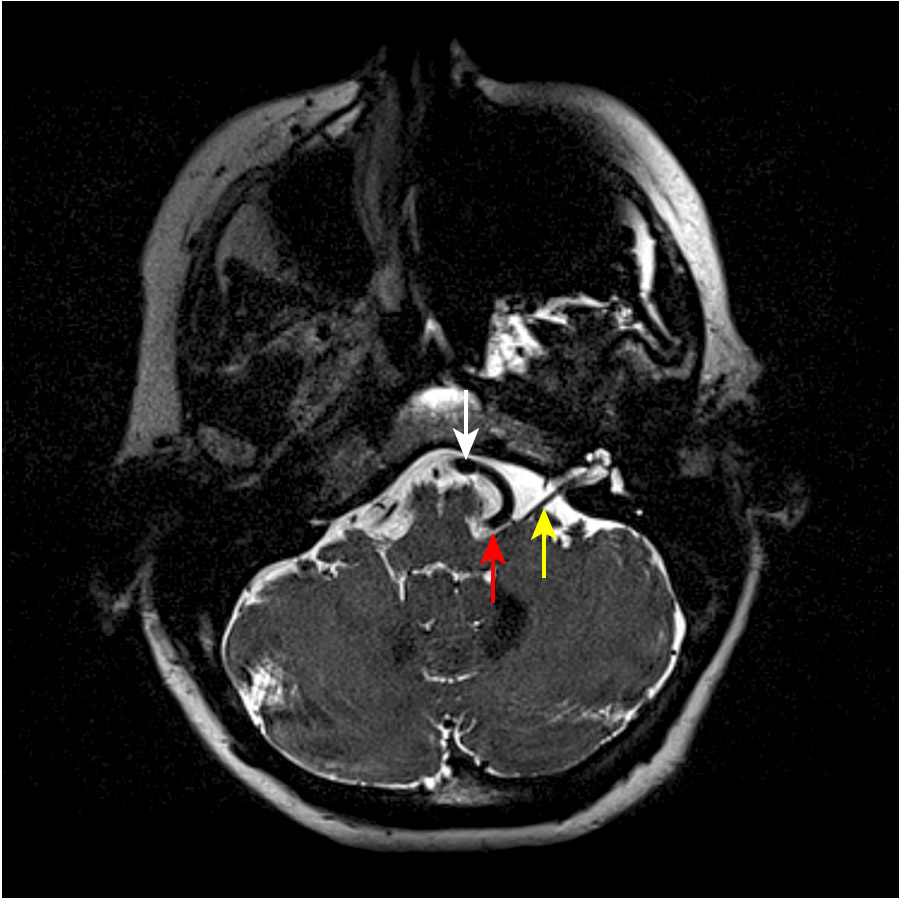 MRI-Aufnahme eines Hemispasmus facialis