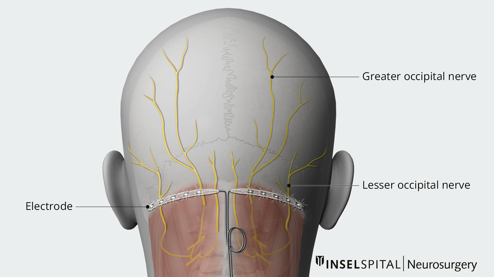 Drawing of the positioning of the electrodes for occipital nerve stimulation