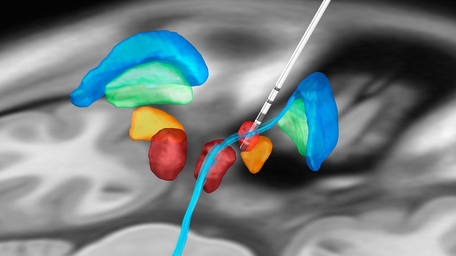 Abbildung einer DBS-Elektrode und wichtiger anatomischer Strukturen für die Stimulation