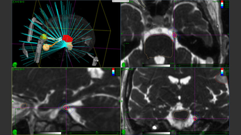 Image d'ensemble pour la planification d'une radiochirurgie stéréotaxique avec représentation du nerf et des zones cérébrales importantes
