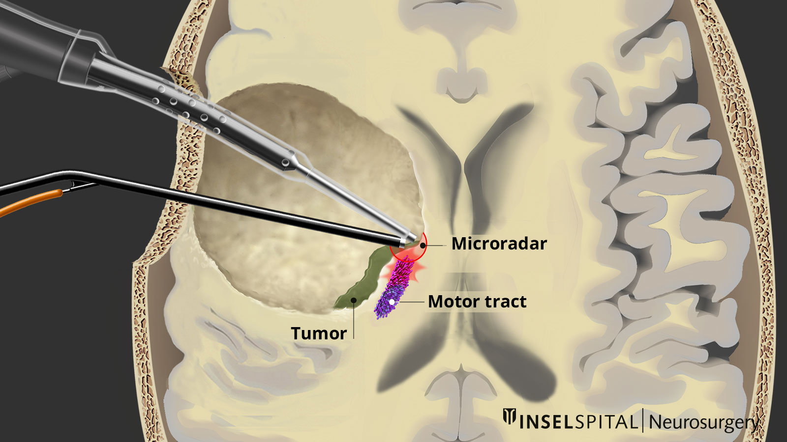 Cross-section of the brain with tumor, motion path and mapping probe. The probe gives a signal and reports the nearby trajectory to the surgeon.
