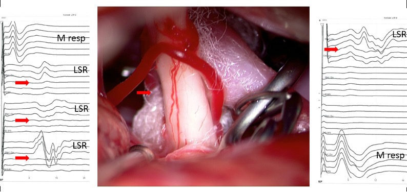 Operation eines Hemispasmus facialis mit Lateral Spread Testung (LSR)