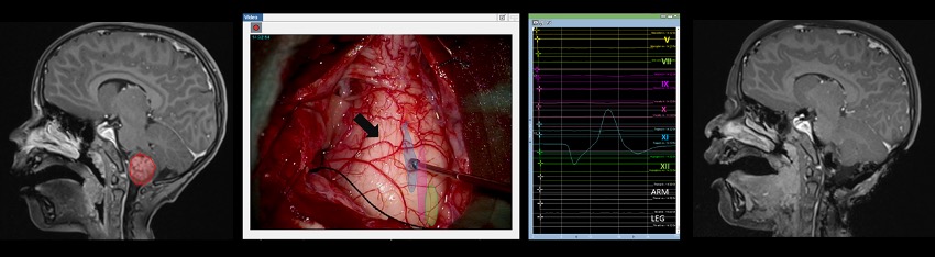 Image en trois parties pour l'ablation sûre de la tumeur par la recherche d'un accès à la tumeur sans lésion des nerfs crâniens