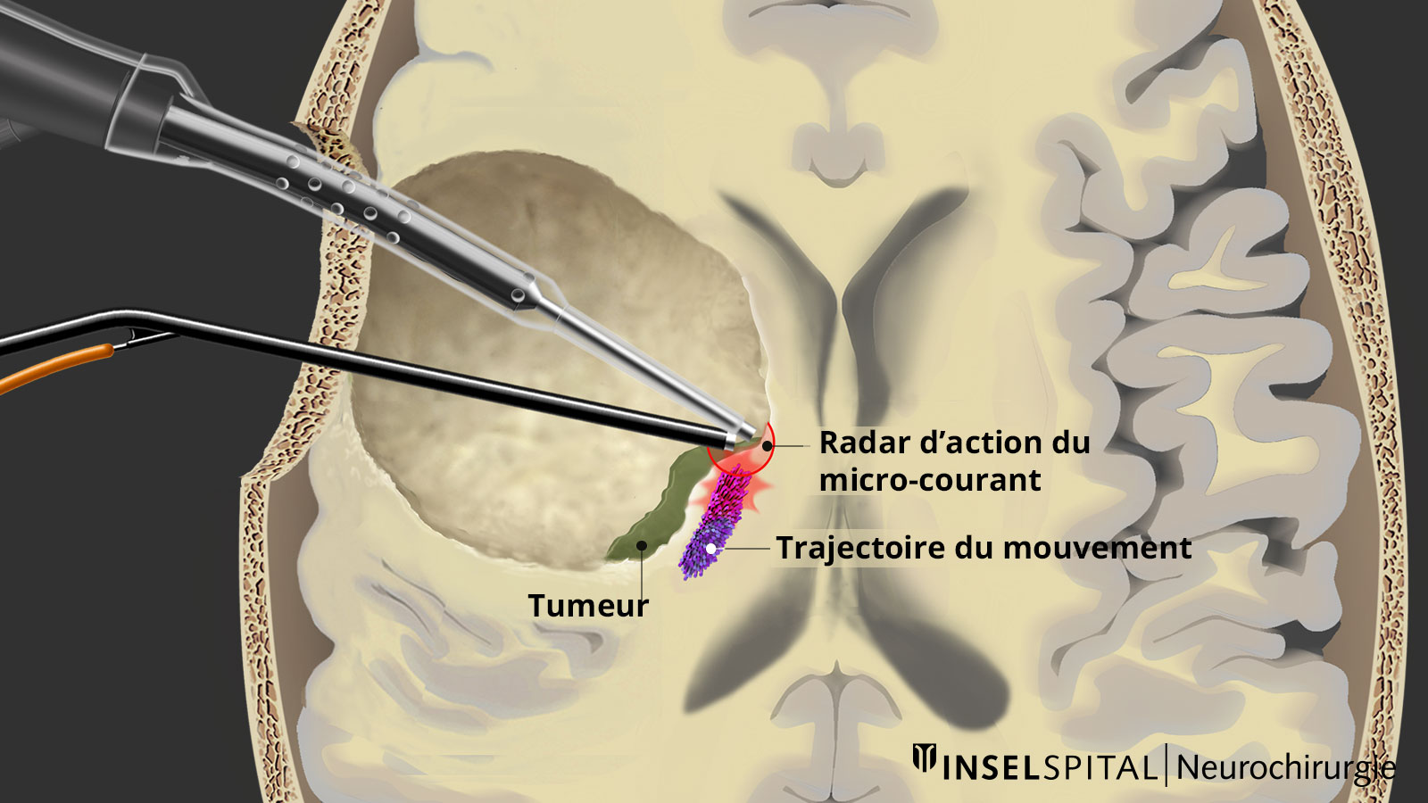 L'illustration montre le radar à microcourants intégré dans l'instrument chirurgical