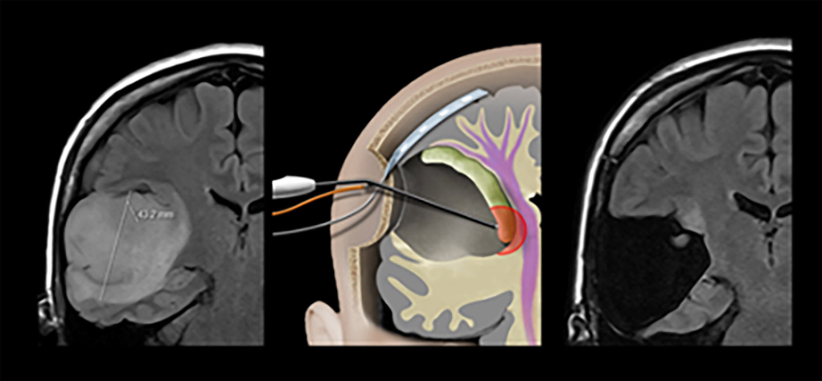 Dreiteilige Abbildung: links MRI vor Tumor-OP, Mitte Zeichnung Neuromonitoring, rechts MRI nach Tumor-OP mit Tumorrest, der aufgrund von Neuromonitoring nicht entfernt wurde