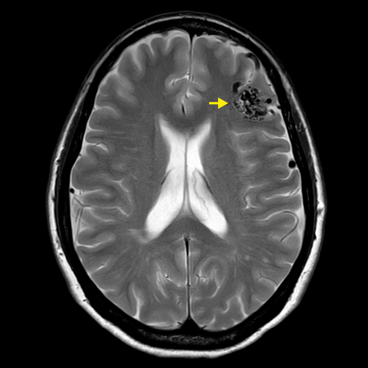 ​Schädel-MRI mit deutlich sichtbarer AVM rechts oben im Bild. Ein gelber Pfeil zeigt zur AVM. Die Gefässe der AVM sind als schwarze Punkte und schlangenförmige Linien zu erkennen.