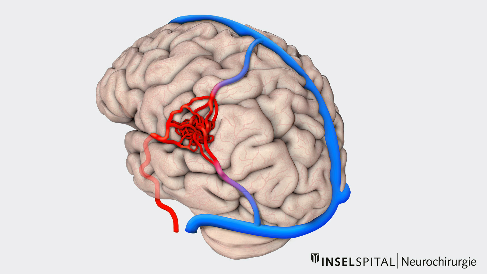 Drawing of an AVM. Blood-supplying arteries in red are directly connected to blood-supplying veins in blue in a tangle of vessels.