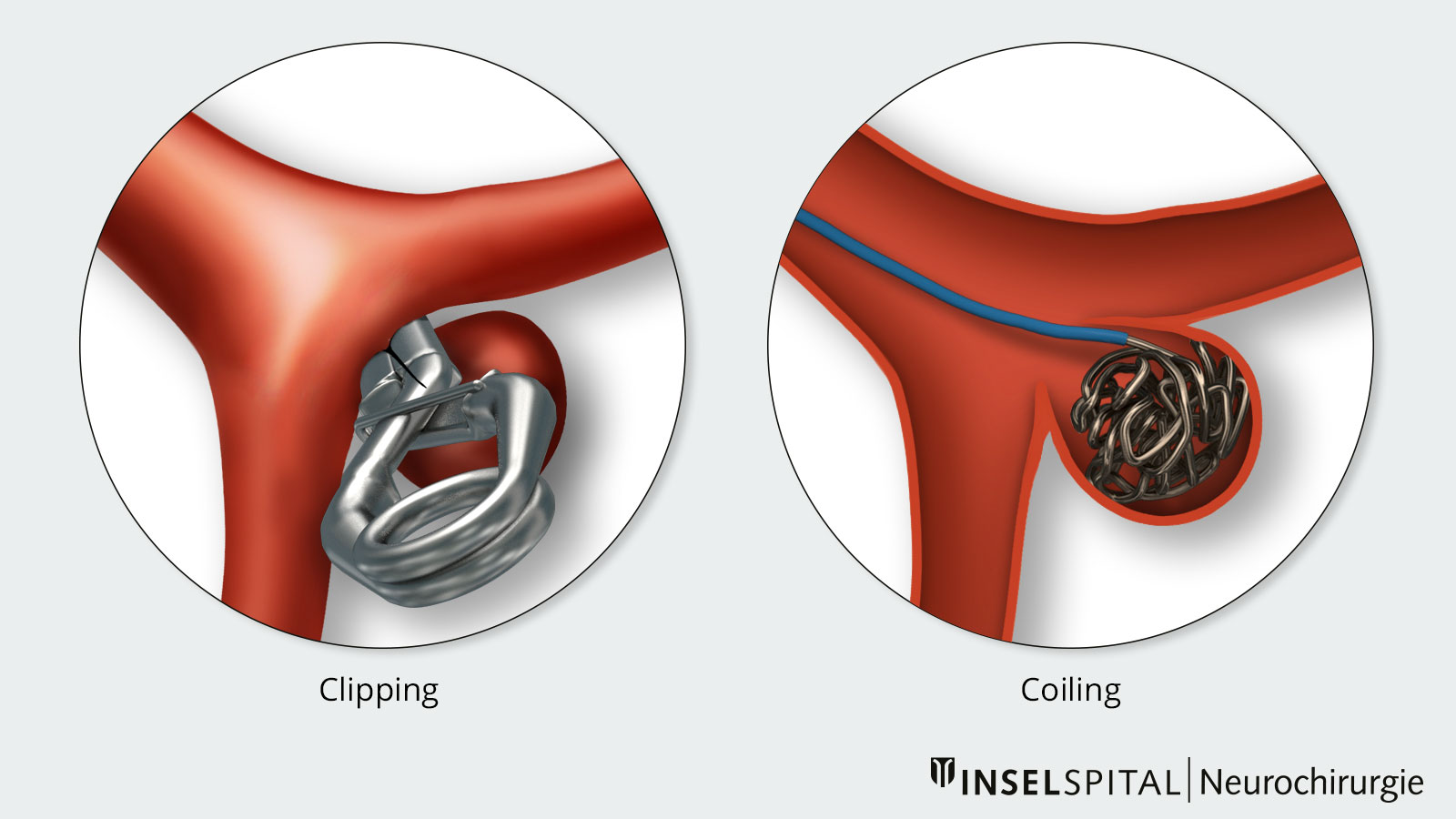 Comparaison entre le clipping et le coiling