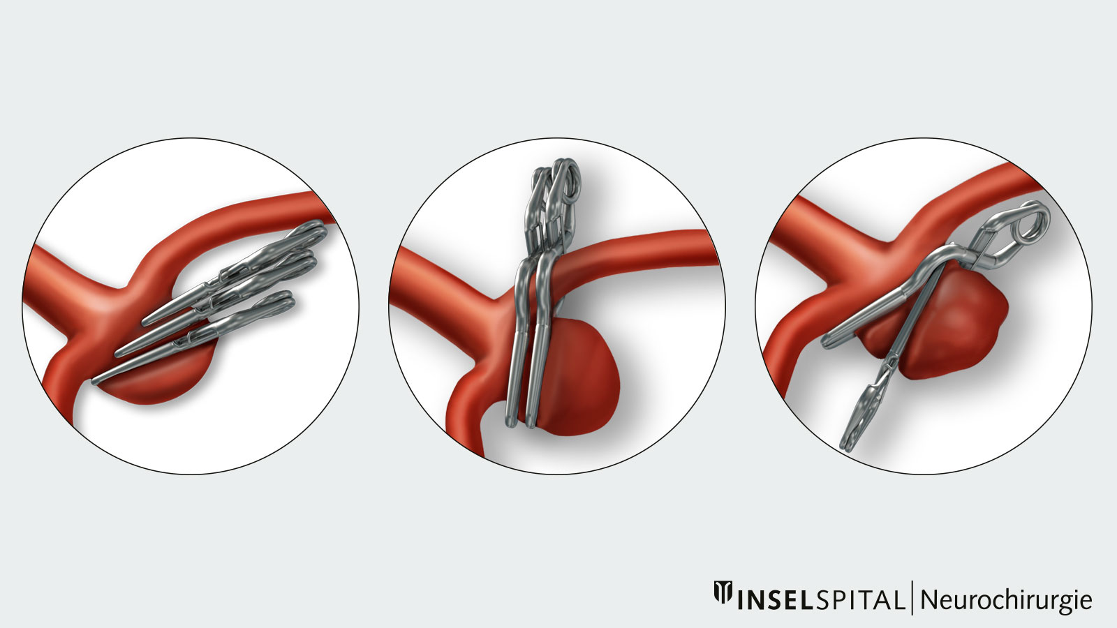 Dessin de différents clips pour anévrisme