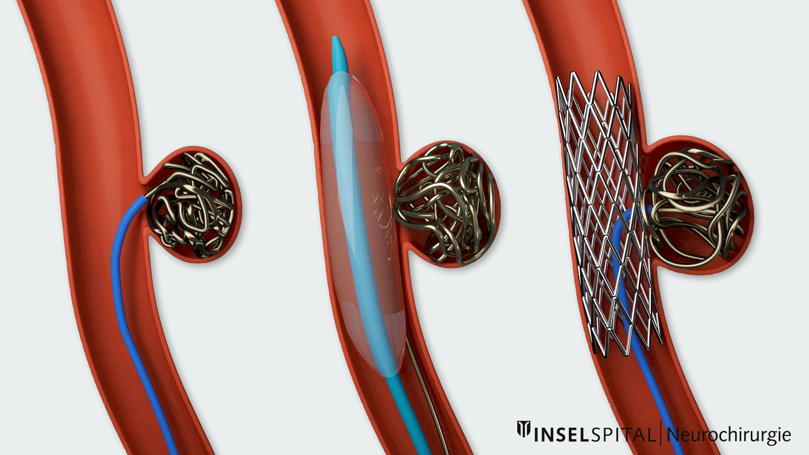 Dessin illustrant les différentes variantes de coiling : uniquement avec des coils, avec des coils et un ballon, avec des coils et un stent