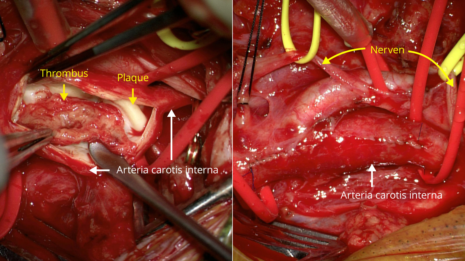 Deux photos d'opération côte à côte. A gauche, thrombus dans la carotide, à droite, photo après l'opération.