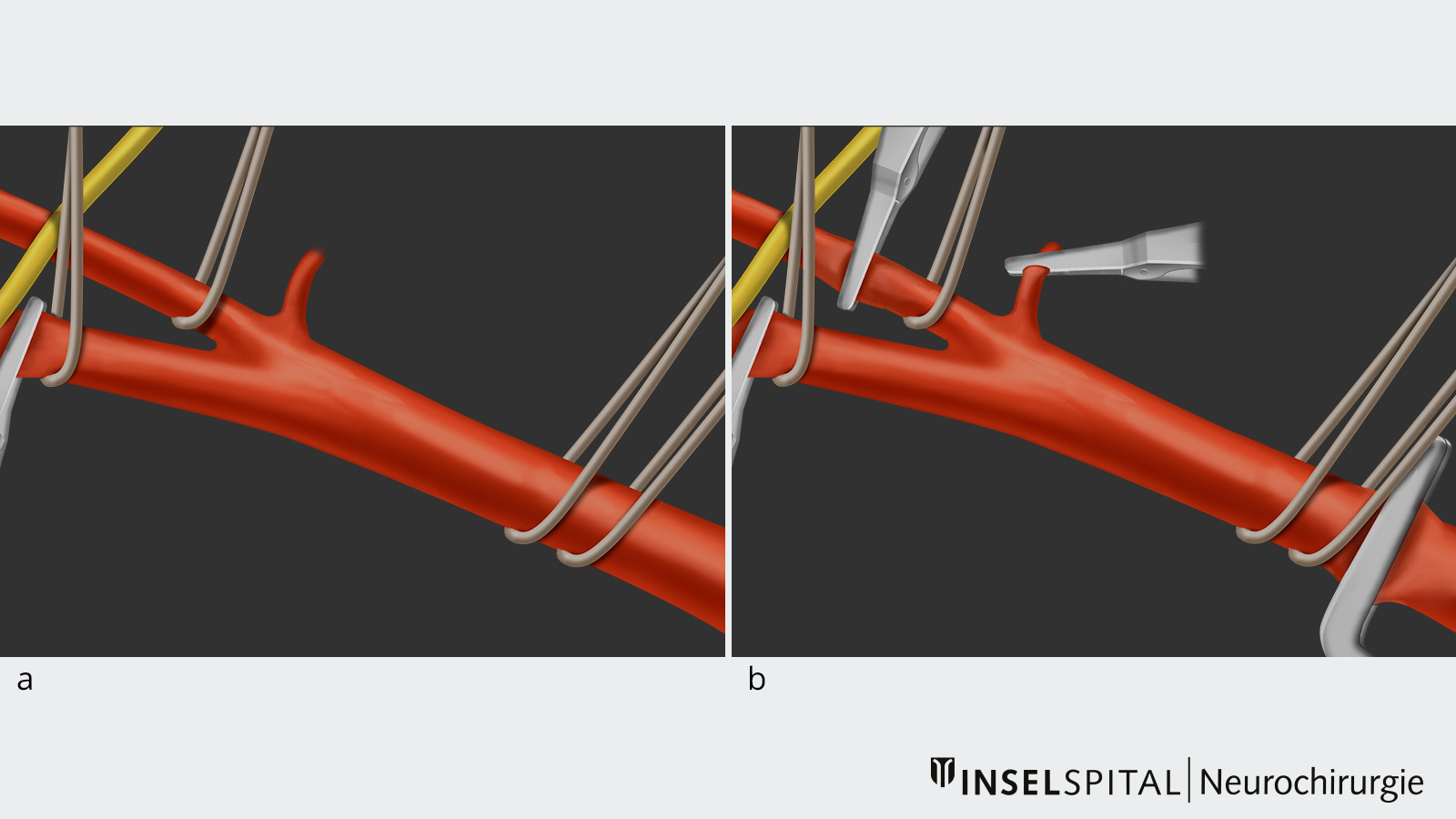 Dessin en 10 parties d'une endartériectomie carotidienne. Chaque illustration partielle montre une étape de l'opération. L'image a Vue d'ensemble anatomique de l'artère carotide commune. L'image b Clampage des artères.