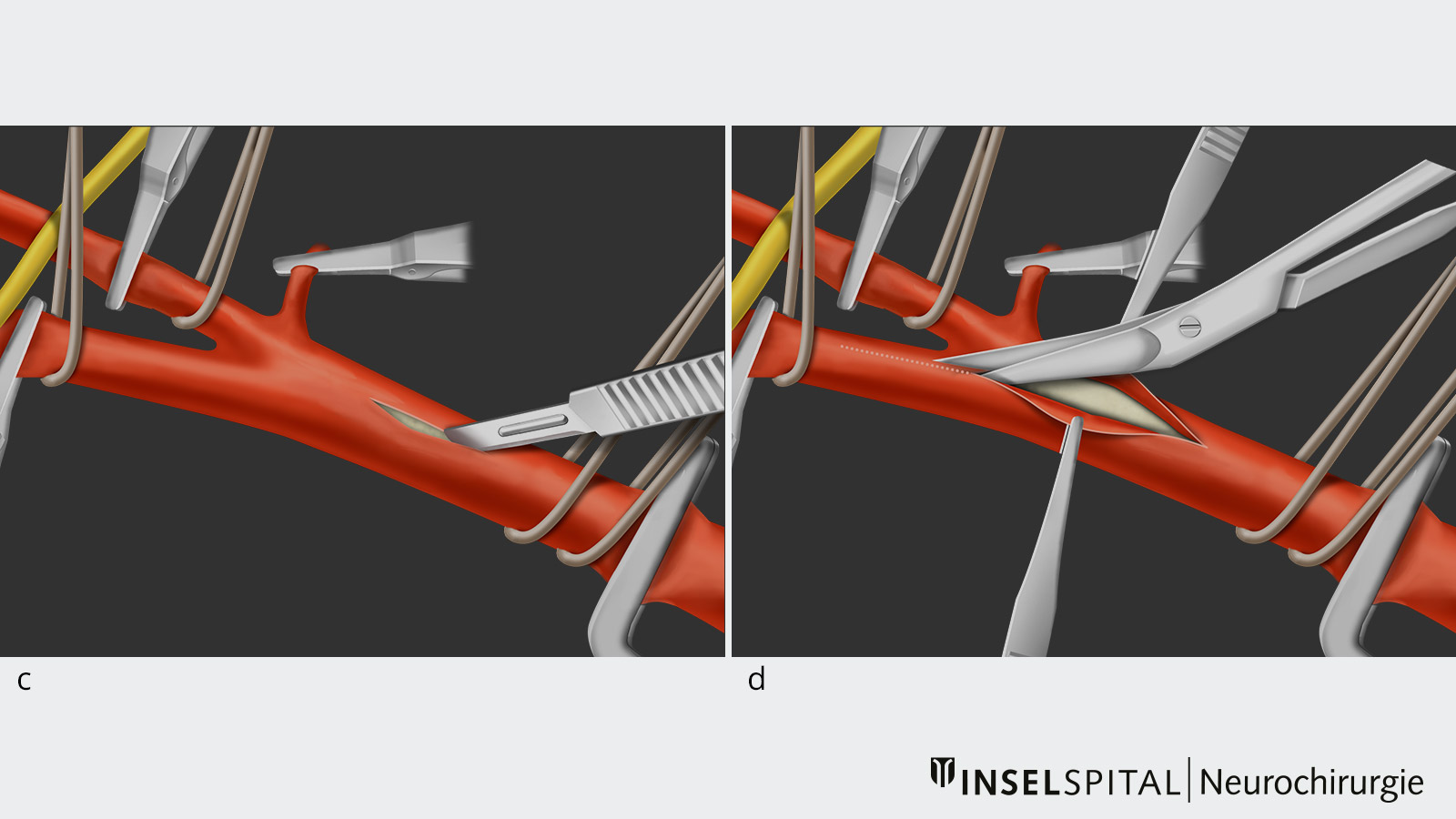 10-teilige Zeichnung einer Karotisendarterektomie. Abb. c Einschneiden der Arterie. Abb. d Schnittverlängerung