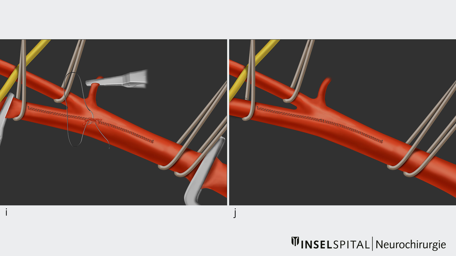 Dessin en 10 parties d'une endartériectomie carotidienne. L'image i Retrait des clamps. L'image j Contrôle final de la suture.