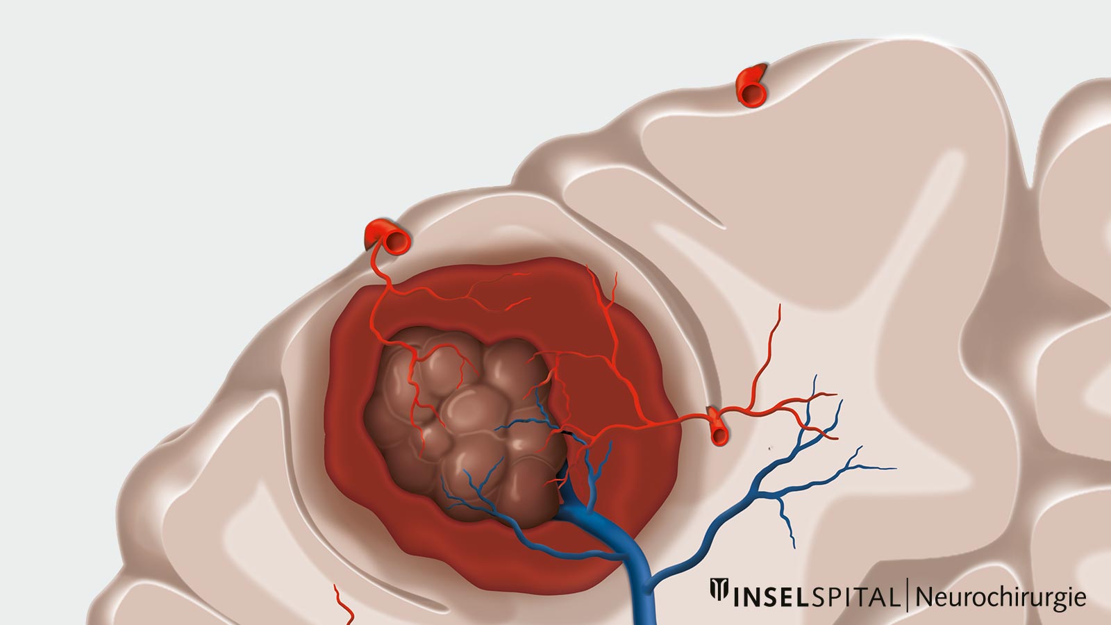 Dessin montrant un cavernome hémorragique. Certains vaisseaux sanguins sont également associés au cavernome (artères en rouge, veines en bleu).