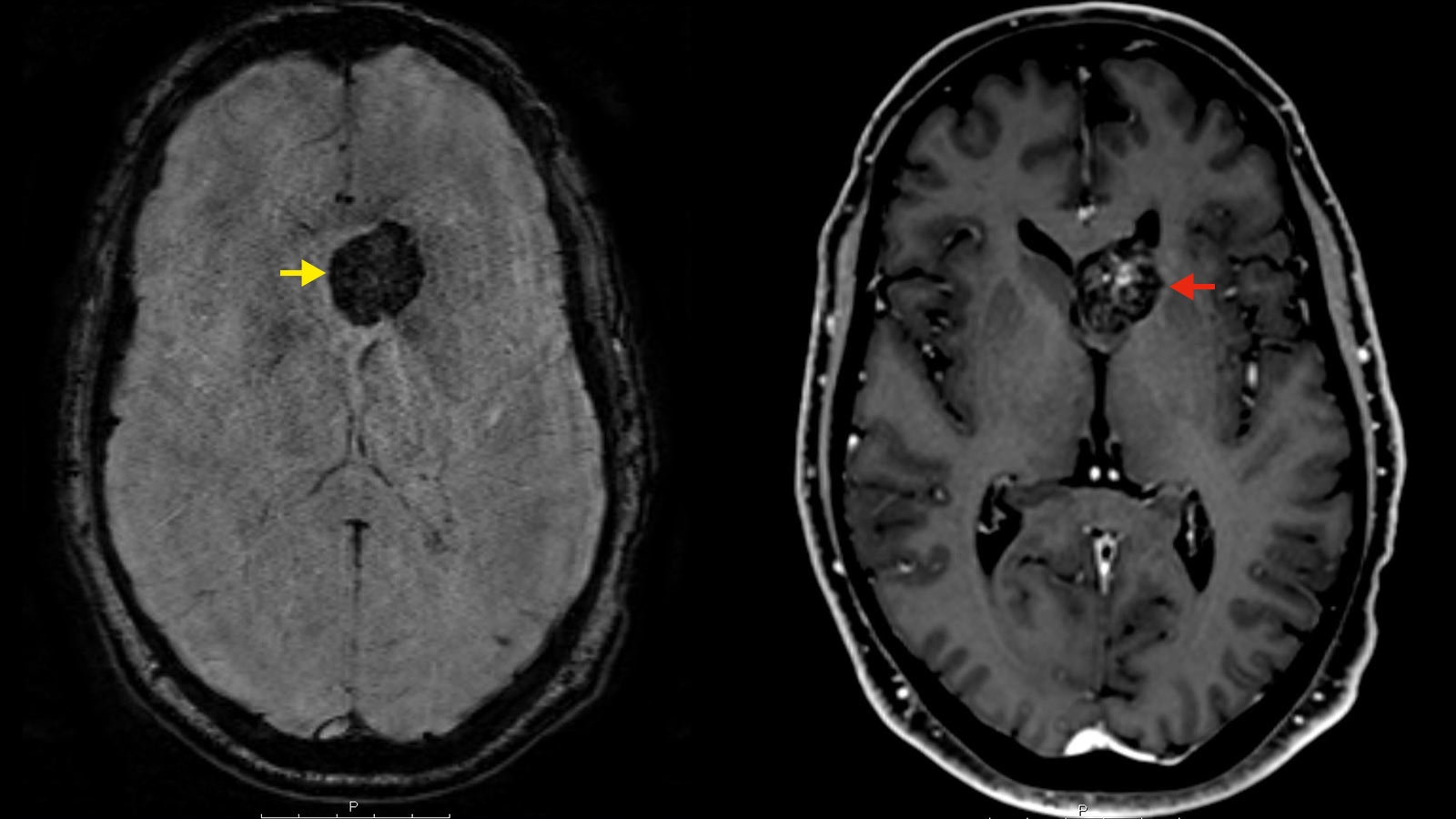 ​Zwei MRI-Bilder eines intraventrikulären Kavernoms nebeneinandergestellt. Links SWI-Sequenz. Das Kavernom ist mit gelbem Pfeil markiert und erscheint im Bild schwarz. Rechts kontrastmittelunterstützte Sequenz. Das Kavernom ist mit rotem Pfeil markiert.