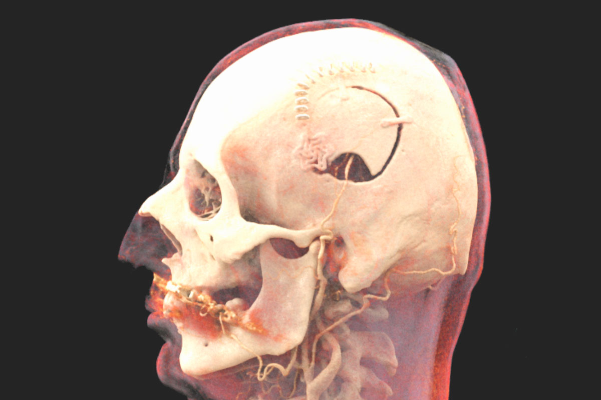 ​3D-Bild nach Kraniotomie mit Gefässverlauf