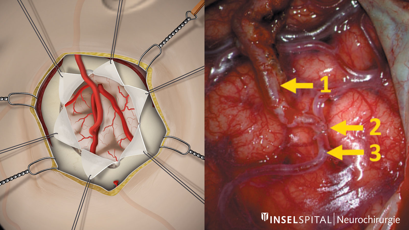 A gauche, dessin d'une anastomose vasculaire avec un vaisseau donneur et un vaisseau receveur, à droite, la même chose en photo d'opération.