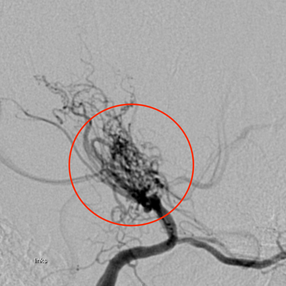 Angiographic image of the collateral vessels. The area appearing nebulous is marked with red circle.
