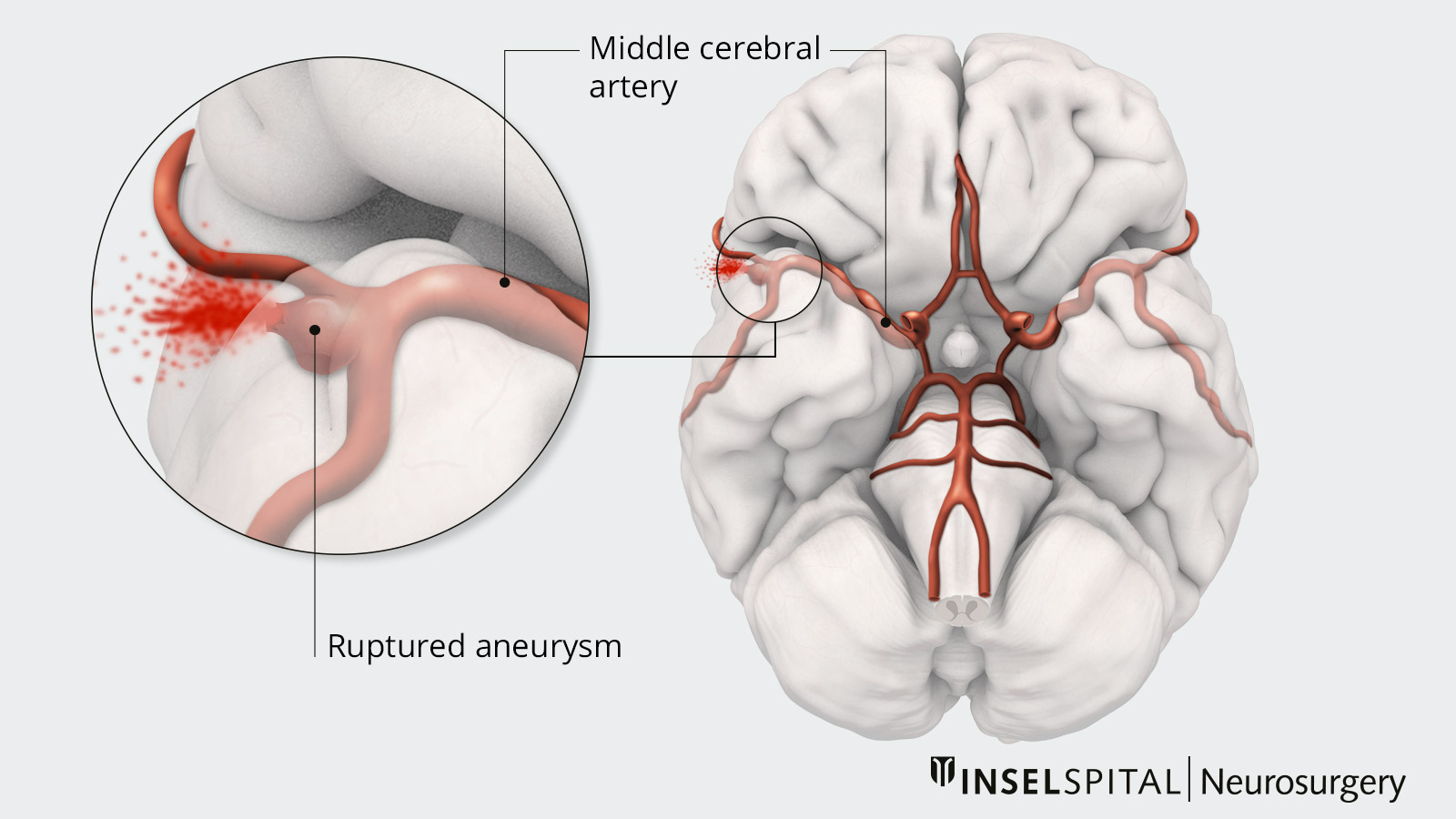 Subarachnoid Hemorrhage (SAH) - Brain, Spinal Cord, and Nerve