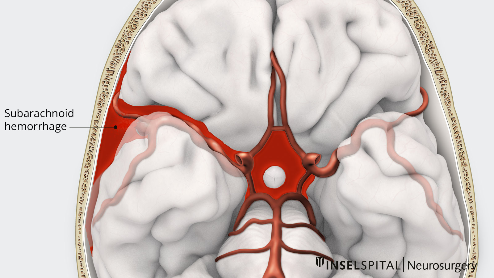 Subarachnoid Hemorrhage (SAH) - Brain, Spinal Cord, and Nerve