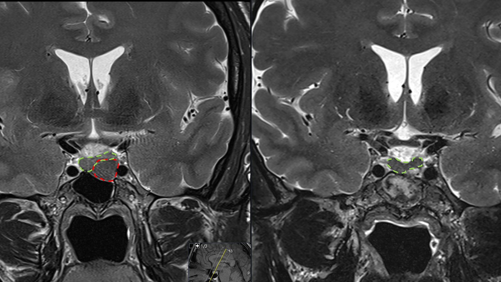 Images IRM comparatives avant et après l'ablation de la tumeur