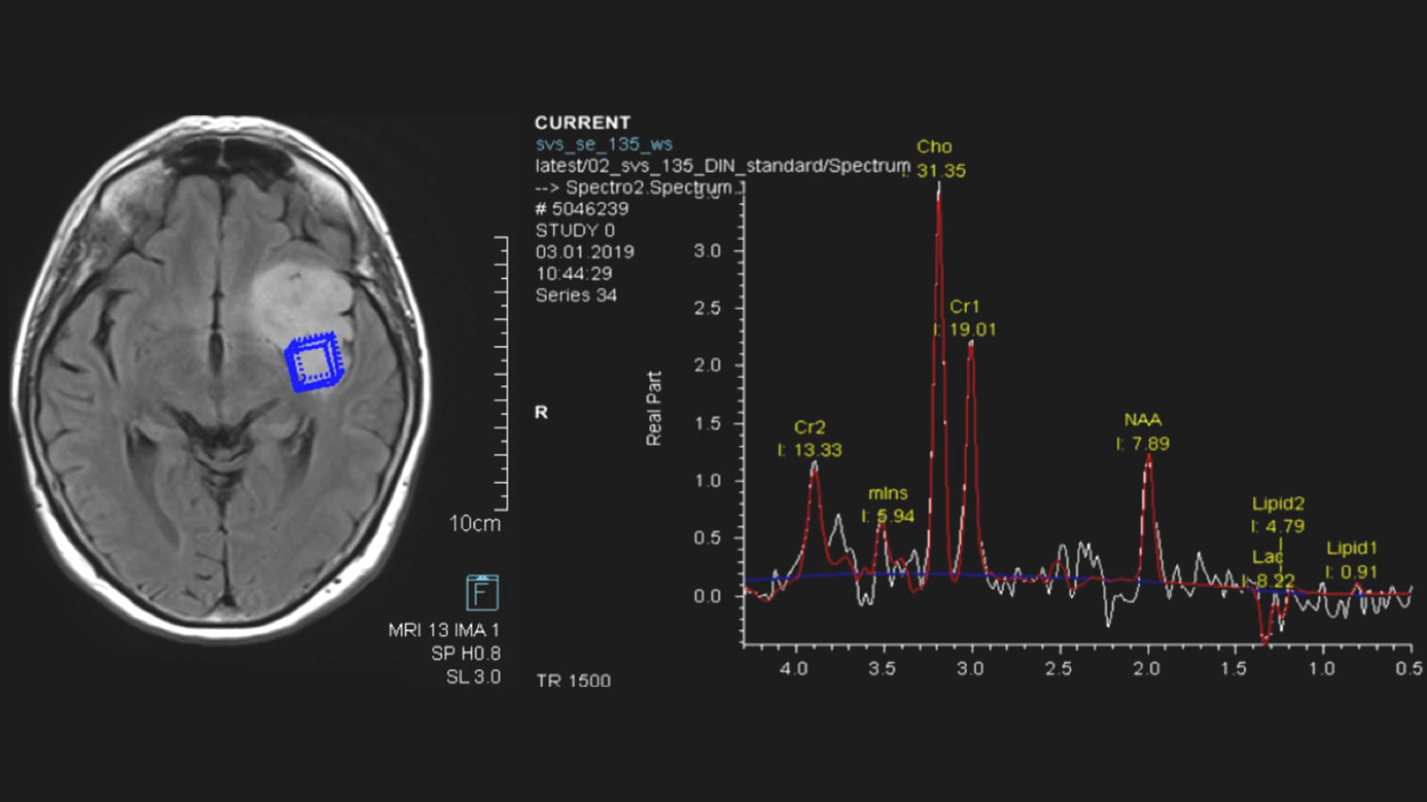 MR spectroscopy shows brain slice with bright tumor on the left. A blue box marks increased concentration of metabolites. On the right, curve diagram with values of metabolite measurement.